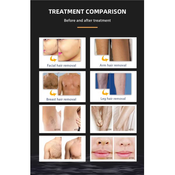 IPL Skin Rejuvenation Hair Removal Machine with Acne/Pigment/Wrinkle/Vascular Removal
