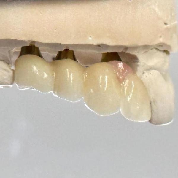 Porcelaine Zirconia Ciment Implanté à vis retenue Forme de tête hexagonale pour une esthétique personnalisée