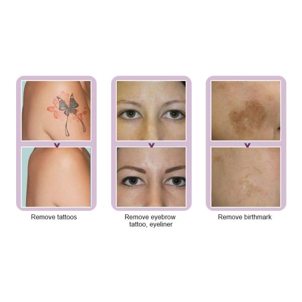 Painfree ND YAG Laser Tattoo Removal Machine , Tattoo Laser Equipment For All Color