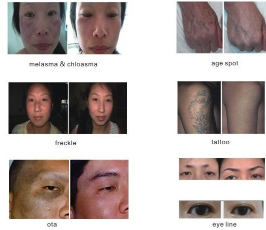 3 In 1 Ipl Rf Elight SHR SHR Hair Removal Machine / Nd Yag Laser Machine