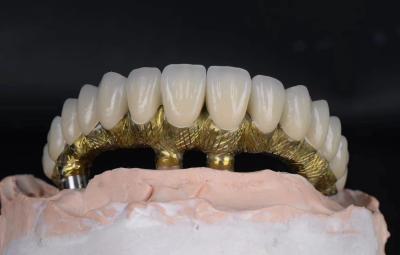 Titanium Alloy Dental Implants And Crowns Natural Looking With Corrosion Resistant