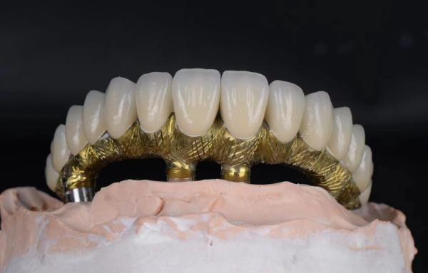 Titanium Alloy Dental Implants And Crowns Natural Looking With Corrosion Resistant