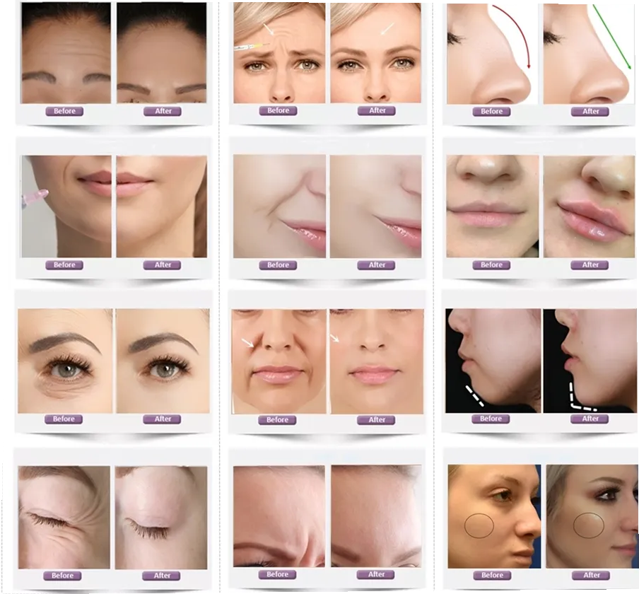 Уменьшающее морщины гиалуроновая кислота Revolax Dermal Filler 2 года