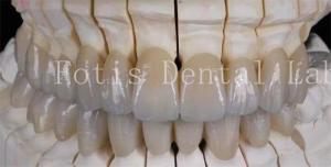 Natural-Looking Smile Prosthetic Porcelain Laminate Veneers Smooth Surface