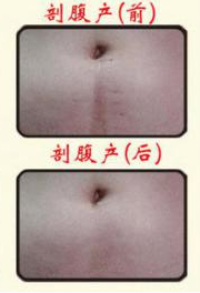 Medical Fractional Co2 Laser For Acne Scars Beauty Salon Equipment 10600nm Wavelength