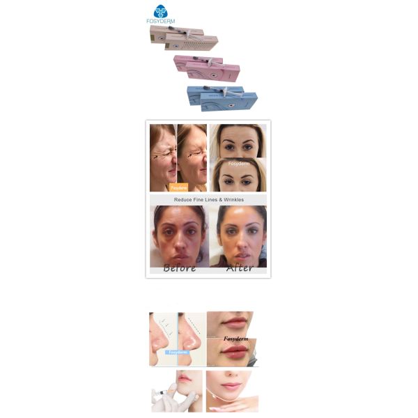 24mg/Ml Cross Linked Hyaluronic Acid Gel Injection