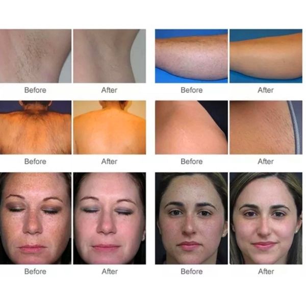 Portable IPL OPT E-light Permanent Laser Hair Removal Device 480nm 530nm 640nm
