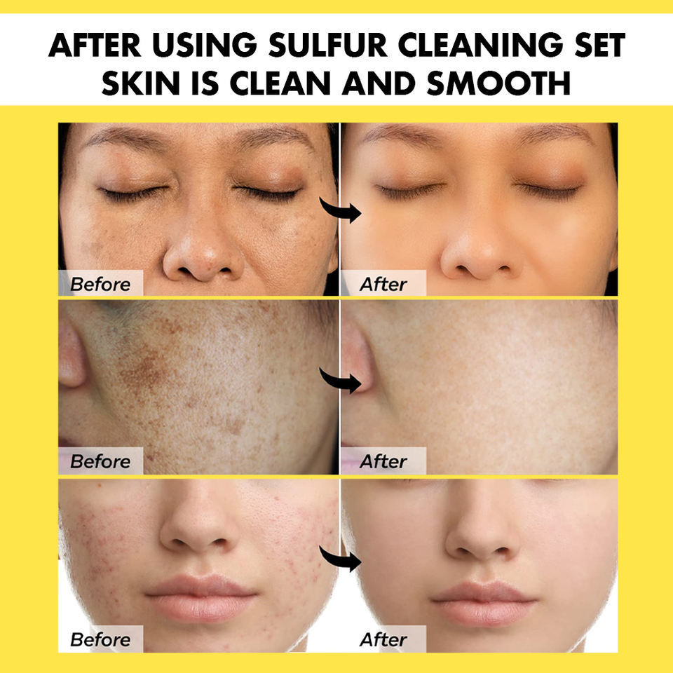 OEM ODM Brand Customized Sulfur Facial Cleanser for Acne Treatment, Pore Tightening, Oil Control, and Facial Whitening