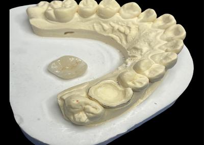 Inlay Dental de Cerâmica Onlay Para Reparação de Dentes, Solução Dental Inlay de Porcelana Onlay