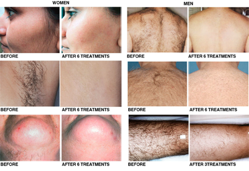 2016 professional portable 808nm diode laser hair removal machine made in china