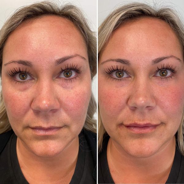Juvederm Anti-Aging Hyaluronic Acid Filler Ultra 4 Ultra 3 And Voluma