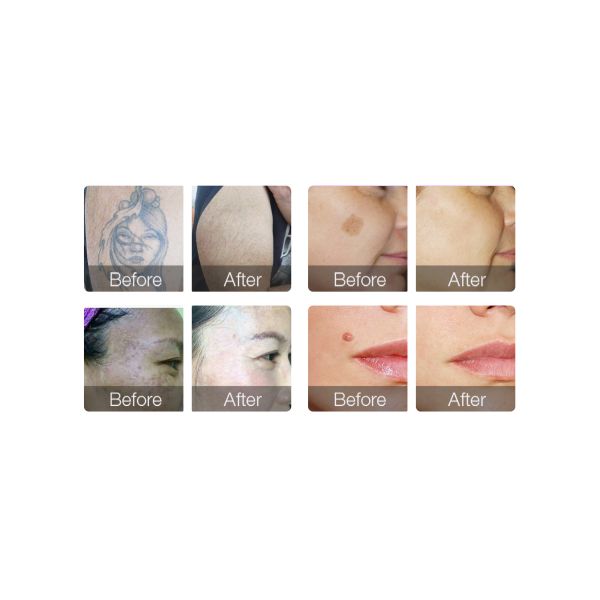 Переключенное q 1064nm удаление татуировки удаления Chloasma Nd Yag извлекает машину лазера пикосекунды пятен