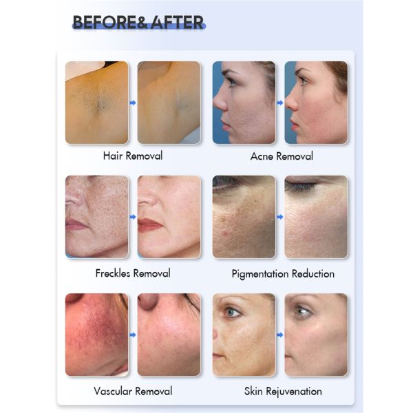 Машина удаления волос лазера веснушки пигмента подмолаживания кожи Dpl E-света OPT IPL