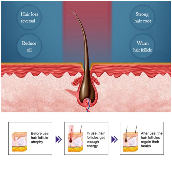 Dispositivo láser de crecimiento capilar con pantalla táctil 160W Terapia láser LLLT para el crecimiento del cabello