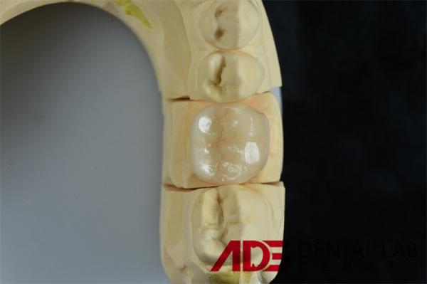 Seamless Porcelain Emax Veneers Teeth Replacement Authentic Looking