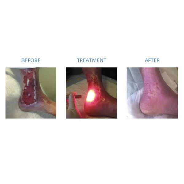 Red Light Laser and Blue Light Source Gomecy Physical Healing 650nm Photodynamic Therapy Laser Machine