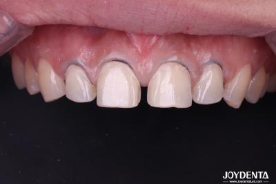 Veneurs de porcelaine dentaire à l' allure réelle, parfaitement adaptés aux dents, veneurs en céramique pour les dents de devant