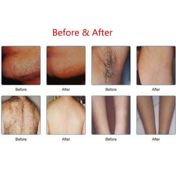 300000 съемок 3 в одной машине удаления волос CE ROHS IPL