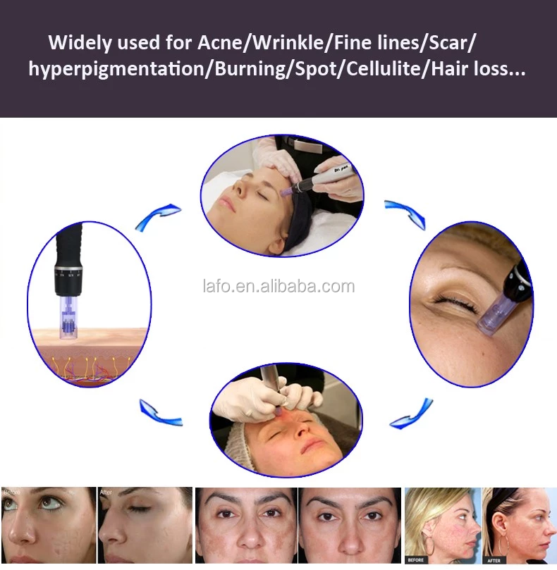 Dr pen M5 gold dermapen anti-aging derma roller pen microneedle therapy skin rejuvenation