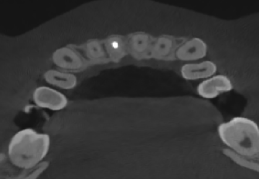 Dental Implant Orthodontic CBCT System High-Resolution 3D Imaging for Precise Diagnosis