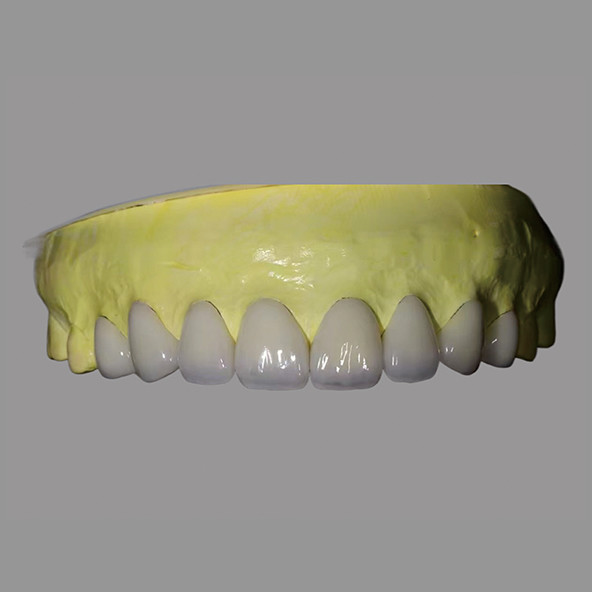 High Translucency IPS E Max Veneers Stains Resistant Biocompatible