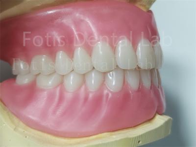 Ivoclar Teeth Full Acrylic Denture Prosthesis Easy To Clean High Durability