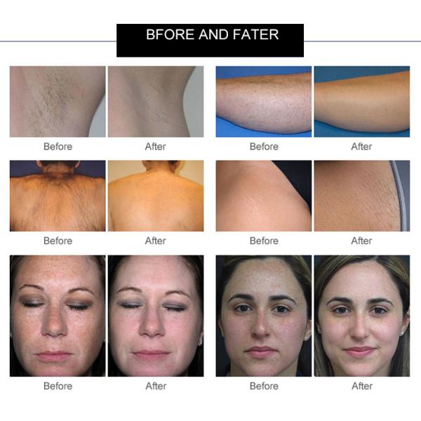 High Power Laser Hair Removal System , Ipl Laser Hair Removal Machine Big Spot Size