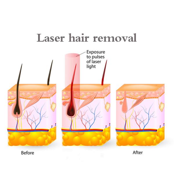 удаление волос льда машины лазера льда сопрано диода 808nm безболезненное
