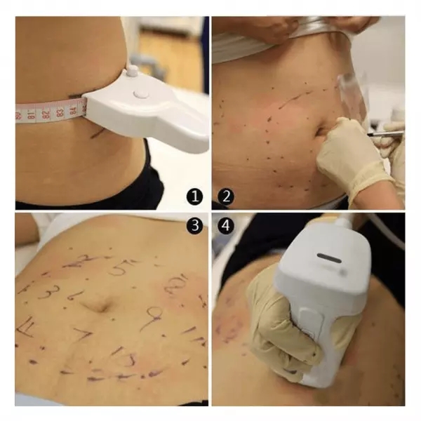 6 In 1 4D Clinic Ultrasound Hifu Beauty Machine