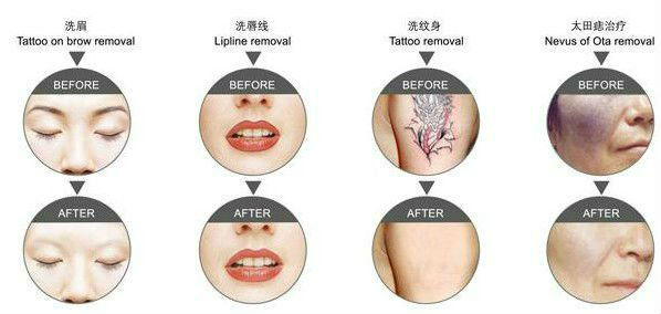 portable q-switch nd yag laser tatoo removal machine