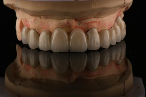 PFM Porcelain Fused to Metal Crowns and Bridges Seamless Bonding for Natural Smiles