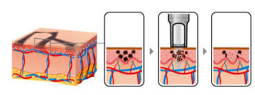 1600mJ ND YAG Laser Machine For Tattoo Removal / Pigment Reduction / Spot Removal
