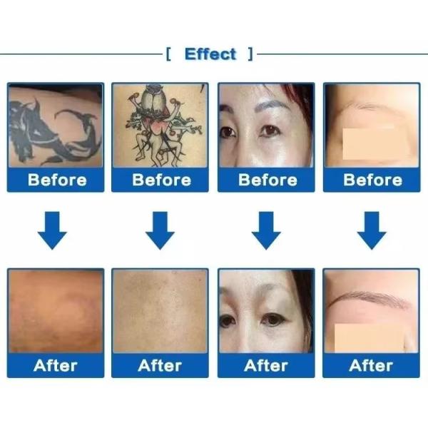 Picosecond 532nm 1064nm 1320nm Remove Tattoo ND Yag Laser Machine