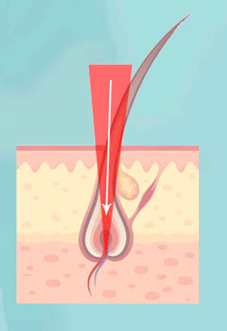 Factory Price Best quality  Vertical 808nm diode laser +RF system hair removal device  salon beauty equipment