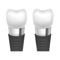Aumentando a estética oral com as barras do implante dental