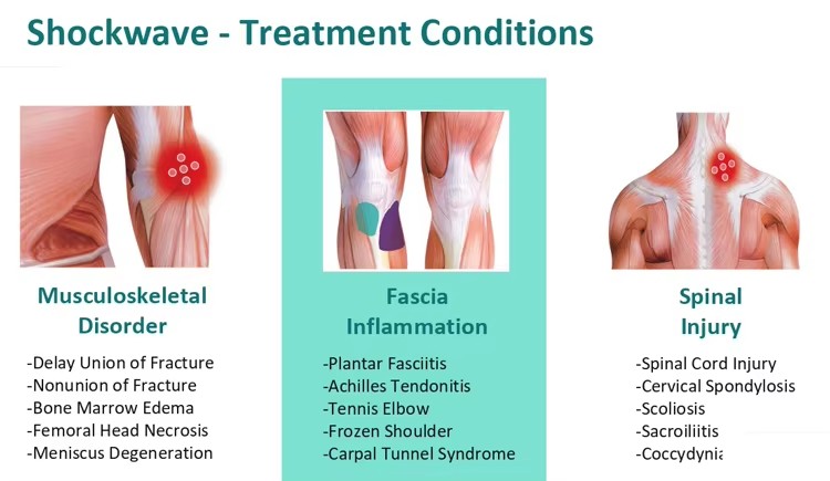 Focus Shockwave Focused Shock Wave Therapy Machine Regeneration Therapy Pain Relief Physio Equipment