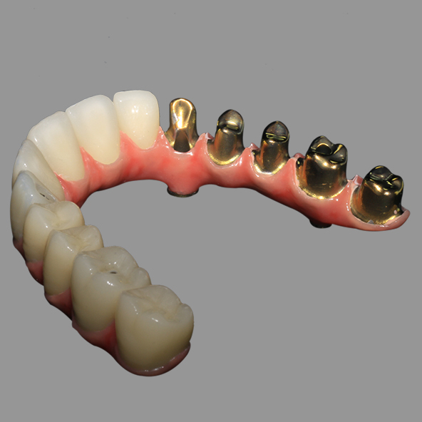 Dental Implant Lab | Class 2 Hybrid Malong Full Arch AOX Implant Bridge Titanium Bar With Full Solid Zirconia