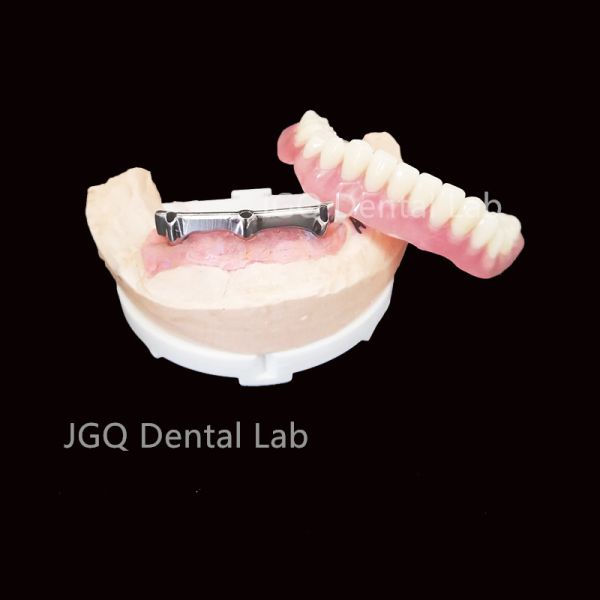 All on 4 Dental Implant Titanium Bar Dentures Restorations