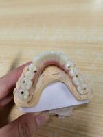 Elevando padrões nosso controle de qualidade da coroa do implante dental