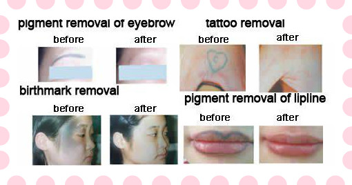 Face SHR Hair Removal Machine , E- Light IPL RF ND Yag Laser Hair Removal Machine