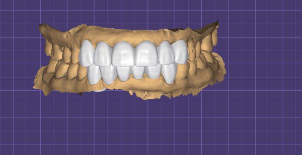 Precision Fit Digital Wax Up Dental Study Model with Durable and Biocompatible 3D Printed Design