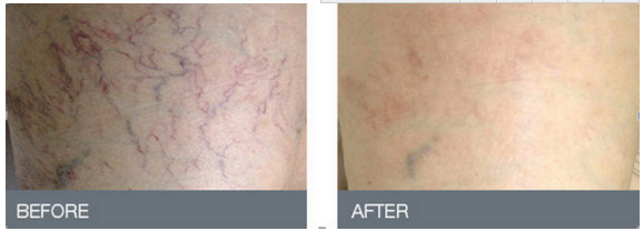 машина AC100-240V удаления пигментацией лазера 15W 30W 60W 980nm