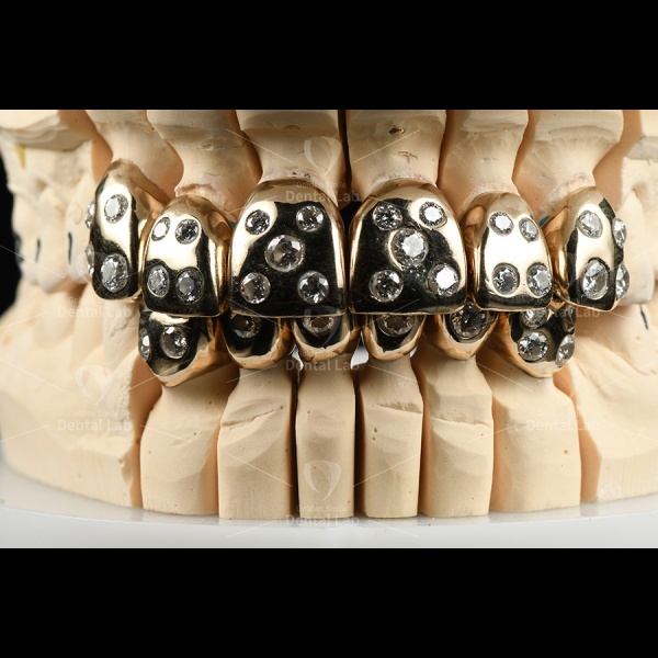 High Biocompatibility Full Cast Metal Crown Yellow Gold With Diamonds