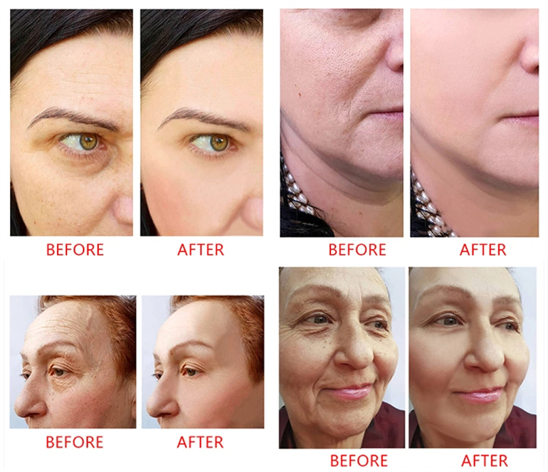 Перекрестный соединенный заполнитель Revolax Hyaluronic кисловочный для удаления морщинки