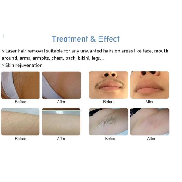 3 Wavelength Diode Laser Hair Removal Machine 755nm 808nm 1064nm Available