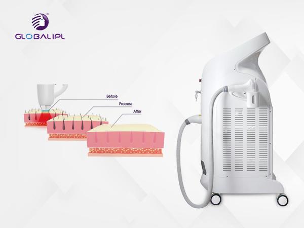 A melhor máquina da remoção do cabelo do laser do diodo do comprimento de onda da venda 755nm 808nm 1064nm três