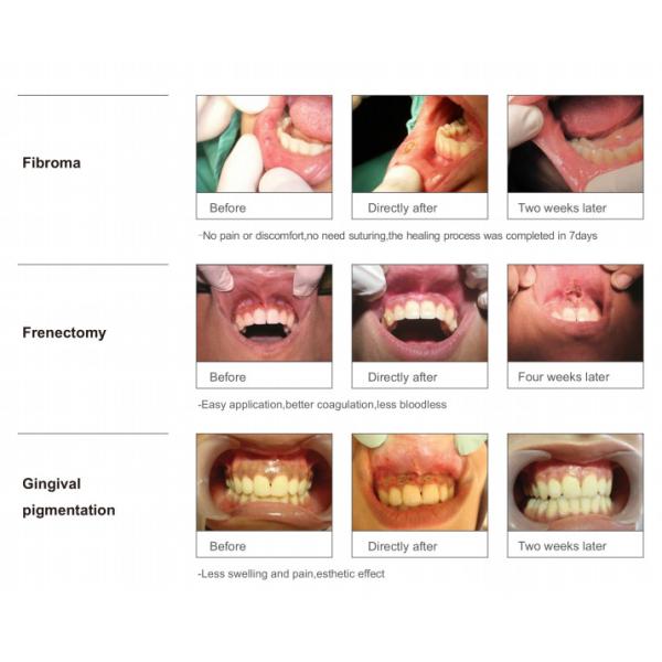 3 Wavelength Medical Diode Laser In Dentistry 450nm 650nm 980nm CE
