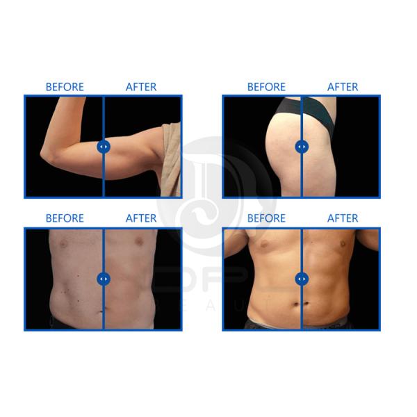 Infrared 5D 8D Roller 360 Rotating Inner Ball Massager  Lymphatic Massage  Cellulite Reduction Buttocks Lift Machine