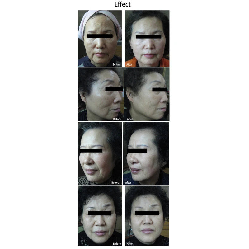The Latest Korea Technology 7d HIFU 30000 shots Facial Lift Anti-wrinkle machine