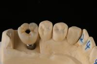 3.75mm Silver Titanium Screw Dental Implant Single Tooth Replacement Implant